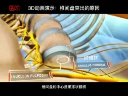 3D动画演示：椎间盘突出的原因