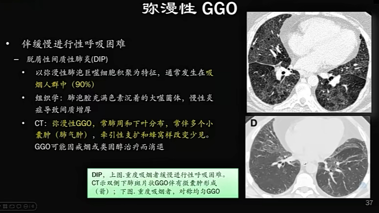 肺 HRCT 诊断思路系列课程崔磊哔哩哔哩bilibili