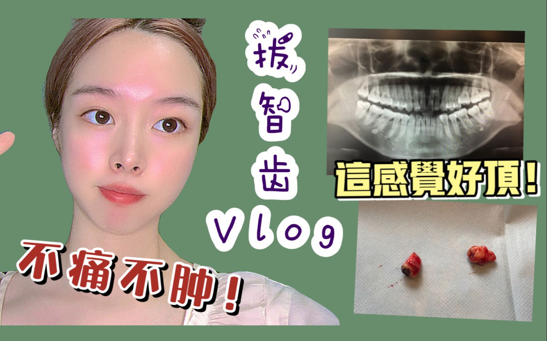 【拔智齿vlog】怒夸无痛微创!全程不到两秒?竟然没有肿!哔哩哔哩bilibili