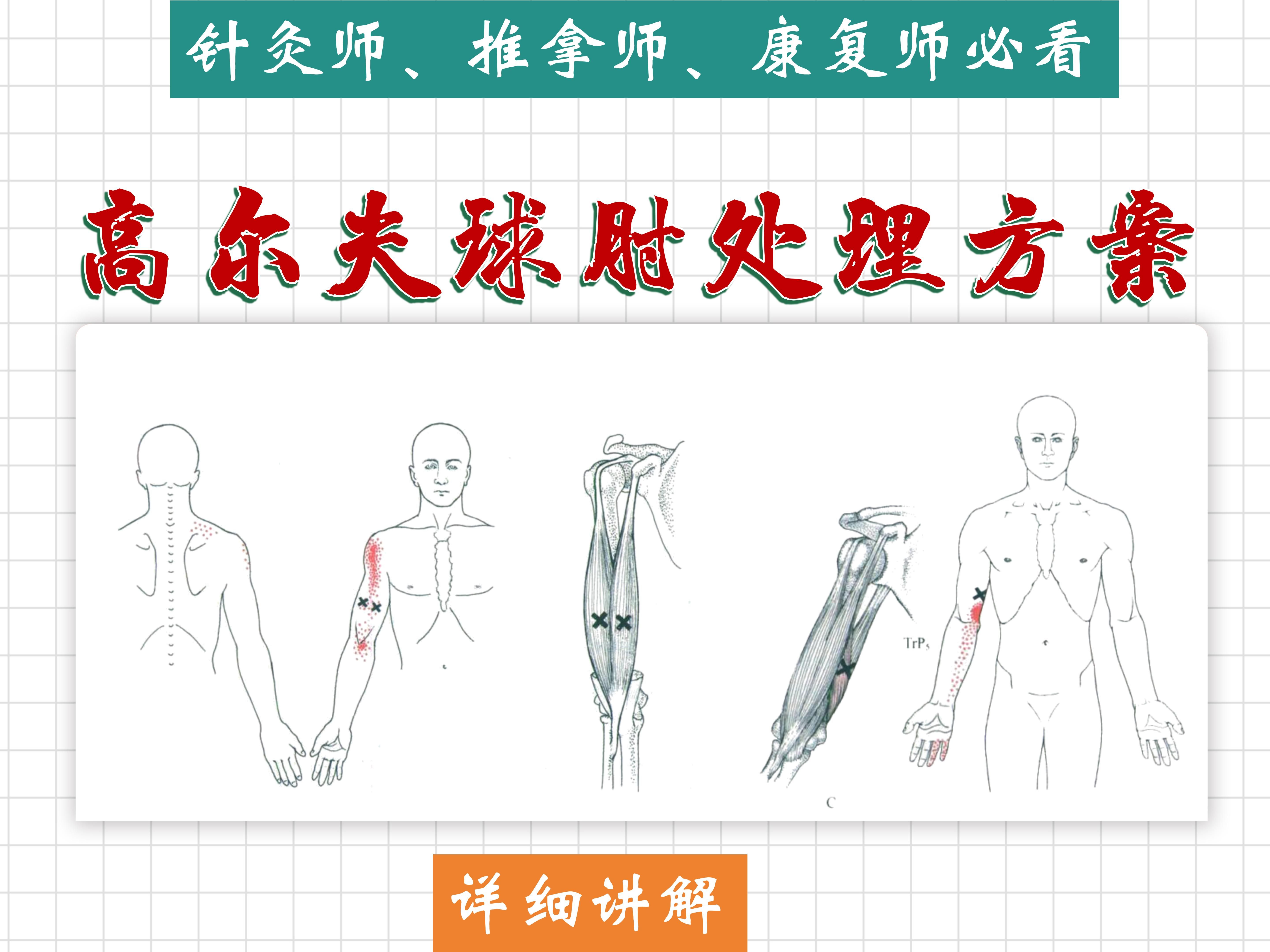 【高尔夫球肘(肱骨内上髁炎)】涉及肌肉详细讲解——位置、功能、激痛点、处理方法——天下明医平台简灵奇针哔哩哔哩bilibili