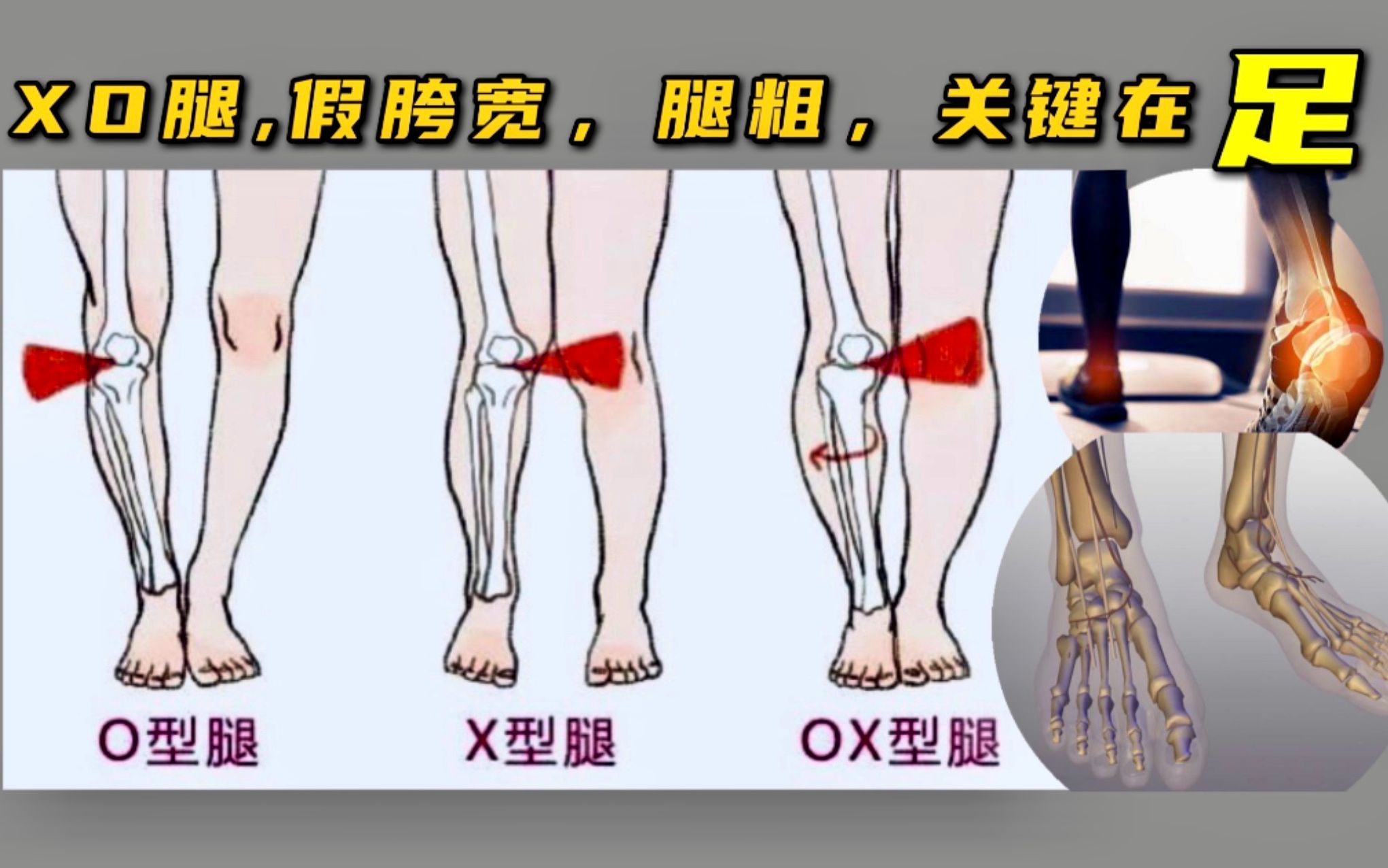 [图]【足部矫正|保姆级跟练】体态篇1+2：改善腿粗、XO腿、假胯宽、踝背屈受限，从源头解决！