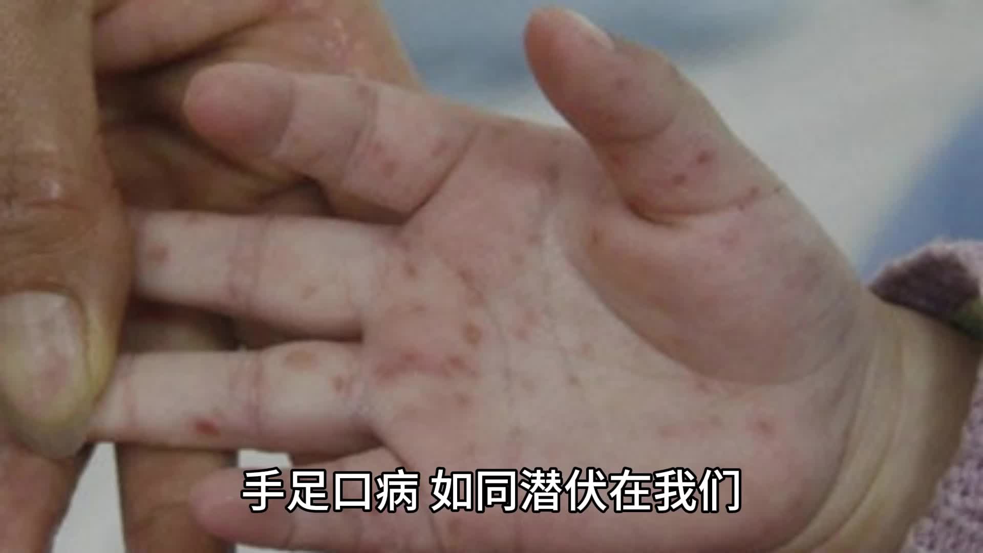 手足口病最怕三種水果,你中招了嗎?