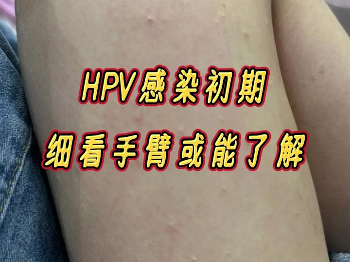 HPV感染初期,看手臂或能了解哔哩哔哩bilibili