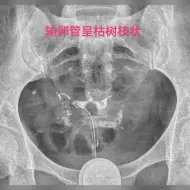 下载视频: 输卵管呈枯树枝状