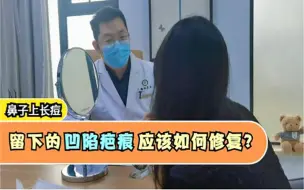 Download Video: 鼻子上长痘留下的凹陷疤痕应该如何修复？