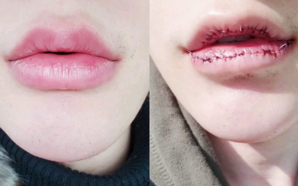 男生厚嘴唇割掉两大块肉后的定期报道第二天