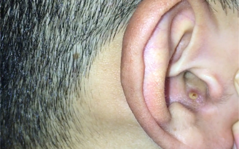 耳朵溃疡图片图片