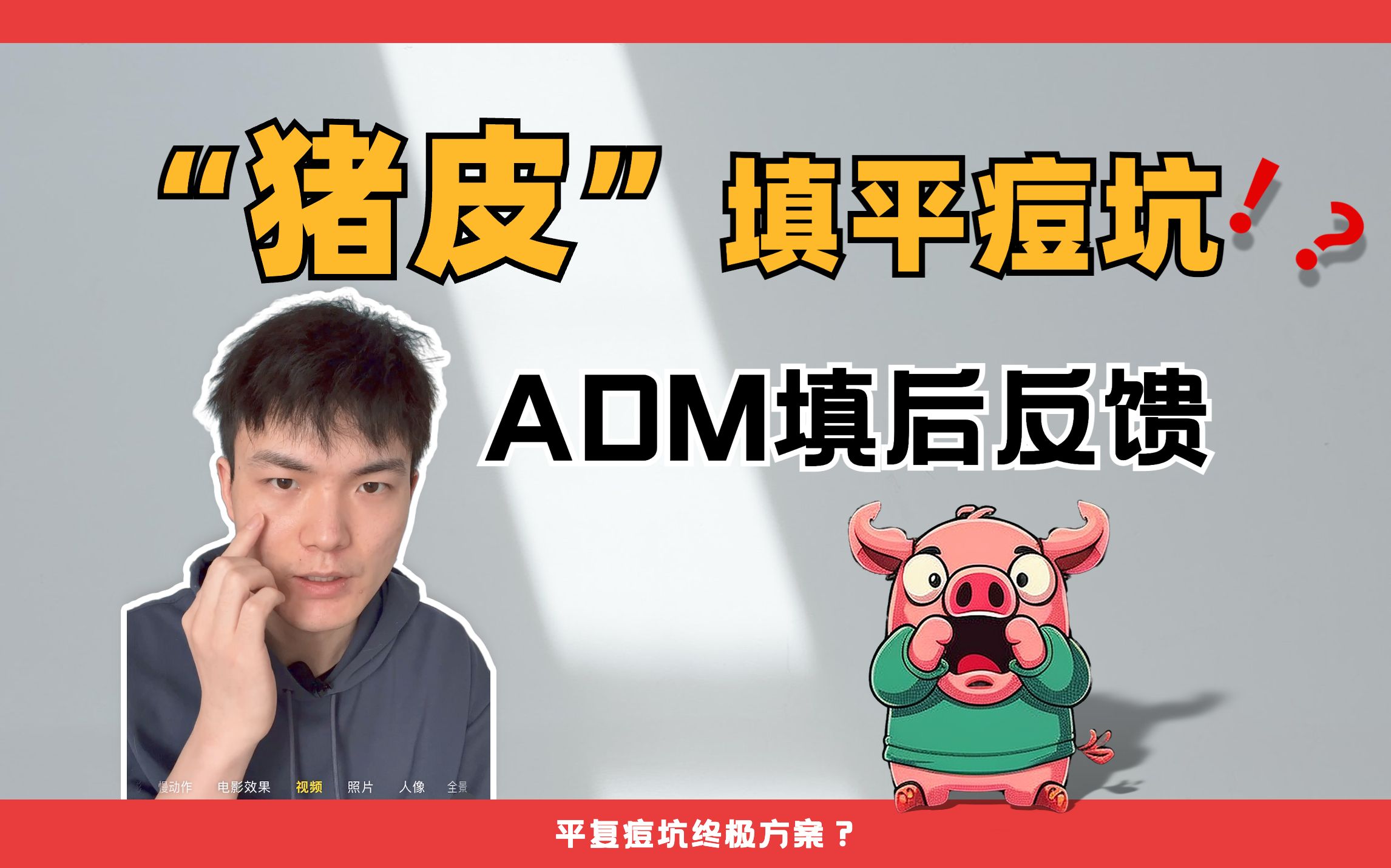 【猪皮可以填平痘坑?】ADM人工真皮填充后的真实反馈.哔哩哔哩bilibili