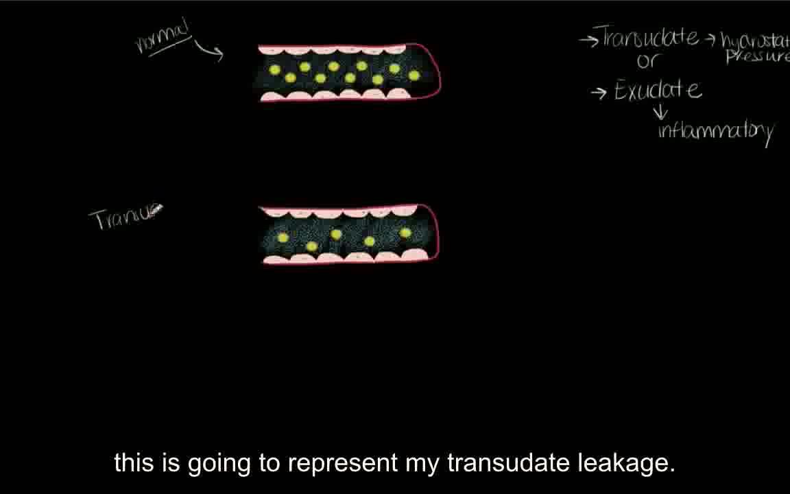 【搬运KhanAcademy】呼吸系统疾病——Transudate vs exudate哔哩哔哩bilibili