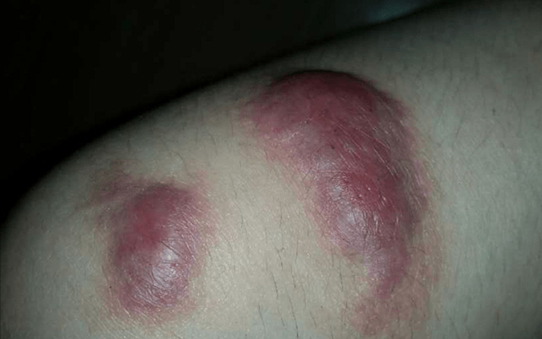 疤痕增生凸起疙疙瘩瘩太难受,每天坚持这几步,抚平增生不焦虑!