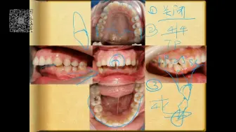 Tải video: 这是我听过最好的正畸课    张栋梁—正畸病例解析