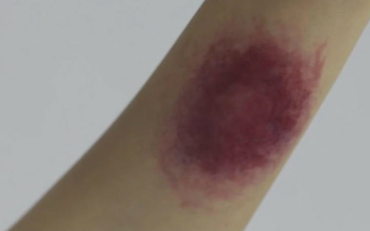 [图]如何制造假瘀伤How to Create Fake Bruises