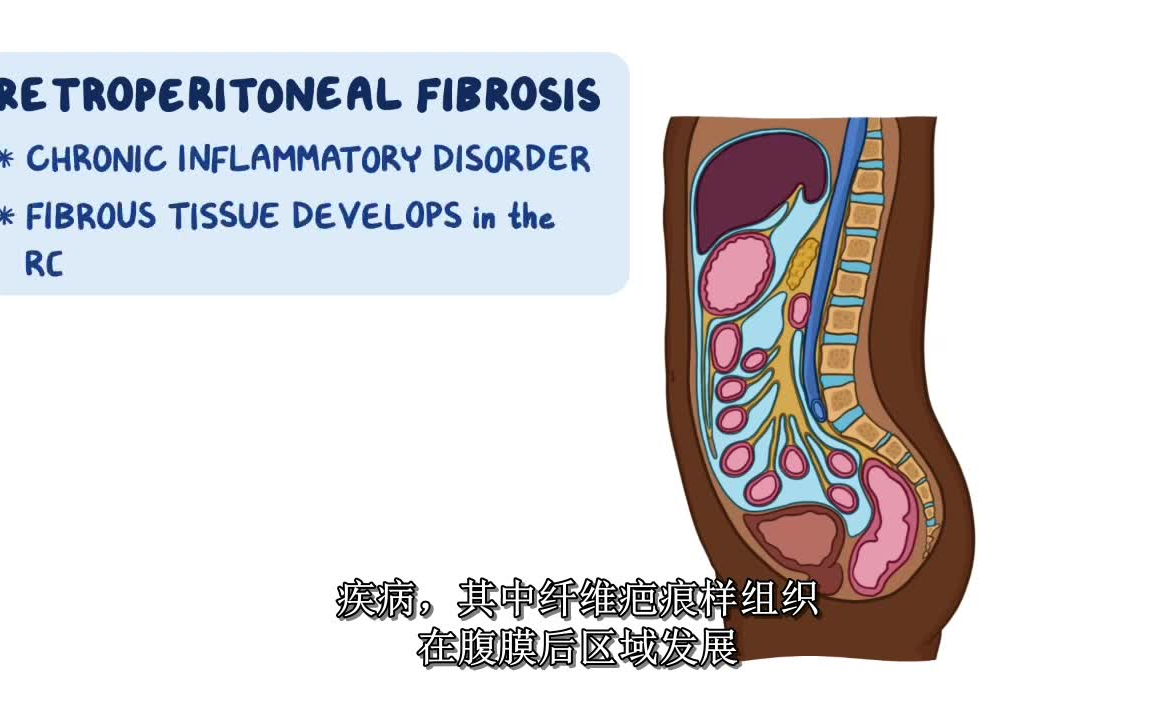 腹膜后纤维化