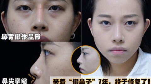 初鼻整形失败带 假鼻子 7年 终完成修复将它 摘 掉 哔哩哔哩 Bilibili