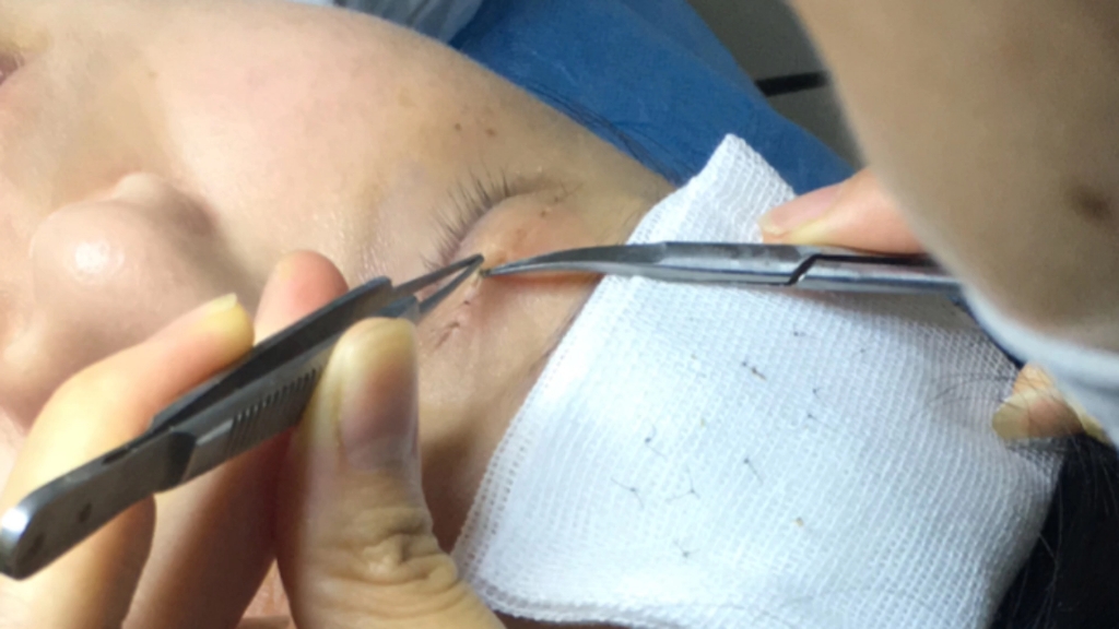 近距离看双眼皮拆线.精细的美容缝合,拆线后只有一条浅浅的痕迹