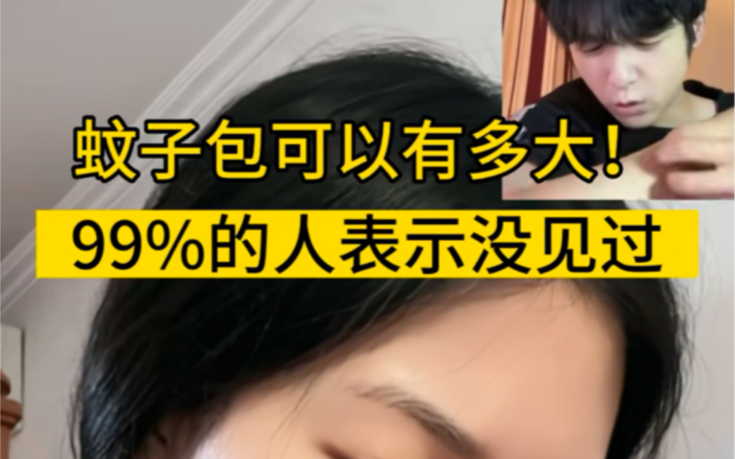 99%的人没见过这么大这么红的蚊子包哔哩哔哩bilibili