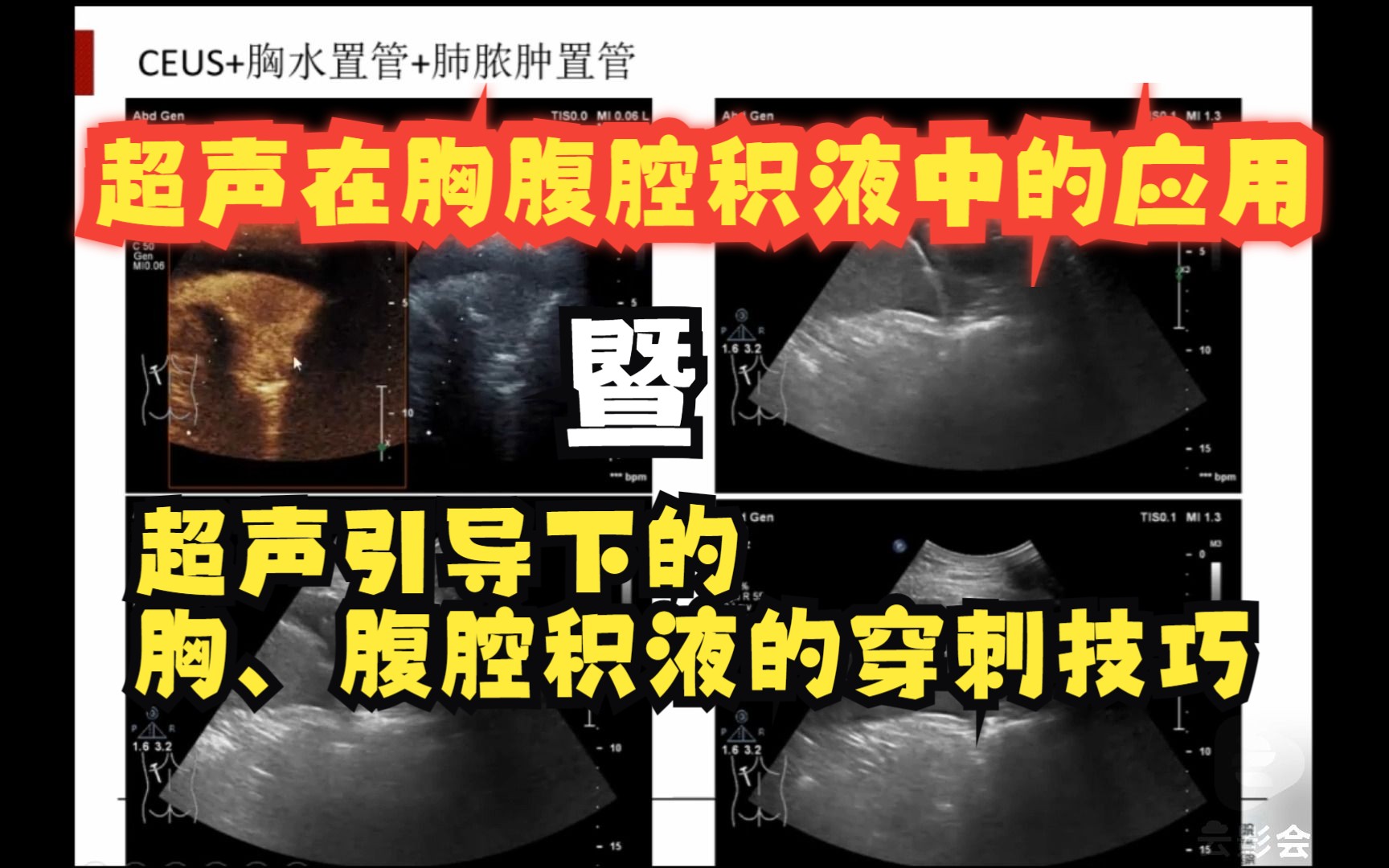 【介入超声】《超声在胸腹腔积液中的应用》暨超声引导下的胸腔及腹腔穿刺实用技巧哔哩哔哩bilibili