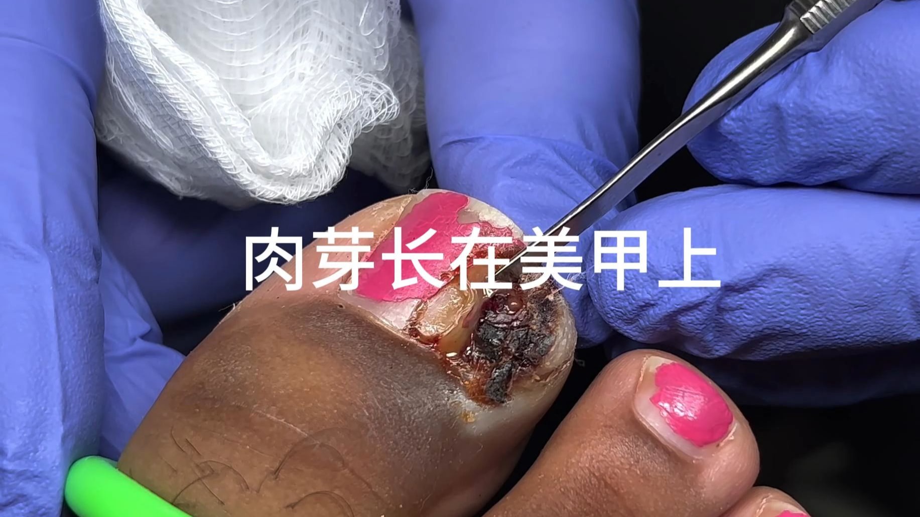 甲沟炎肉芽长在美甲上