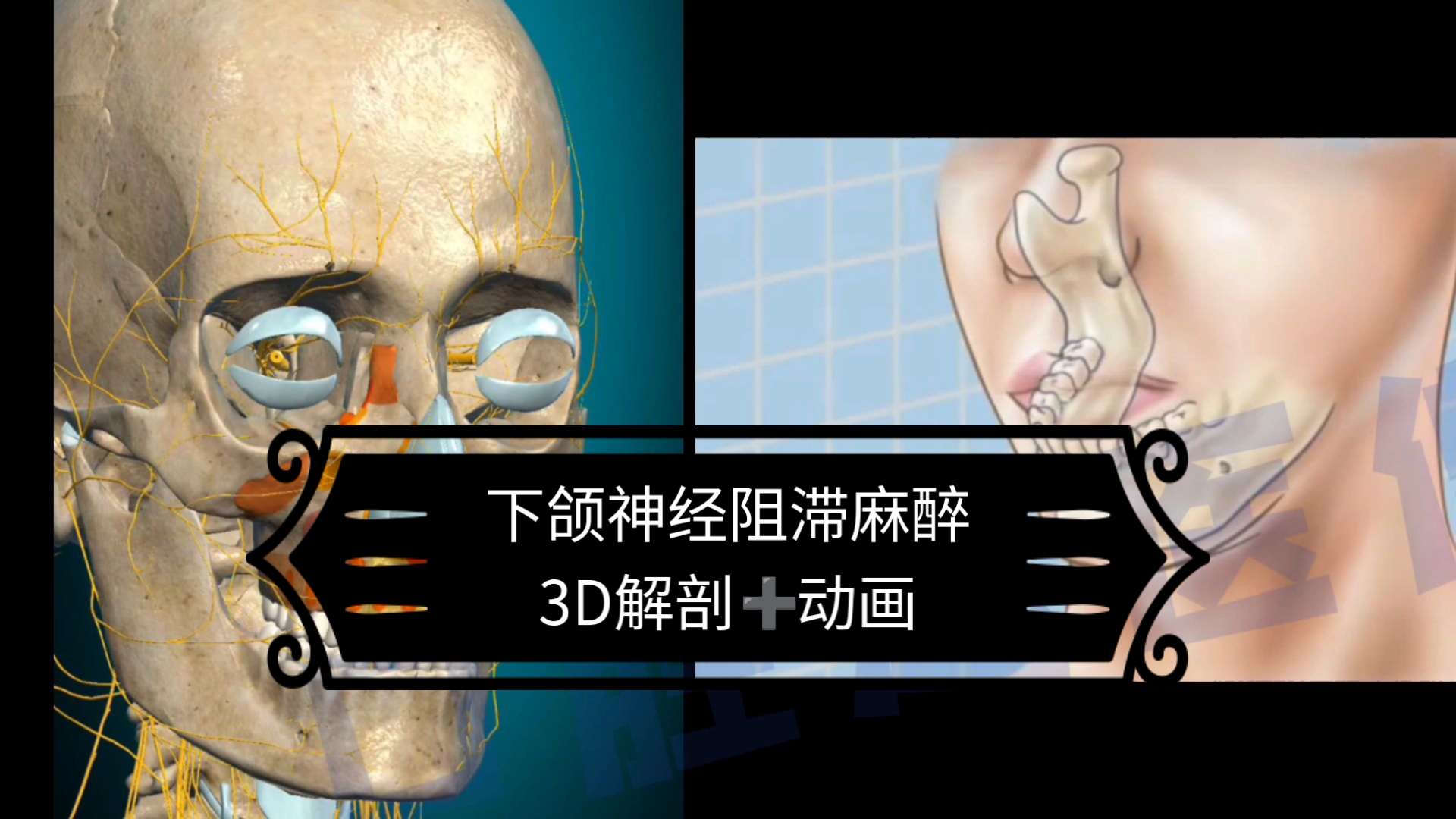下颌神经阻滞麻醉(3d解剖➕动画演示)