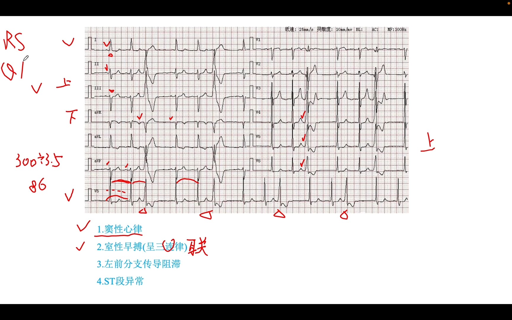 心电图五步读图法之窦性心律,室早三联律,左前分支传导阻滞,ST段异常哔哩哔哩bilibili