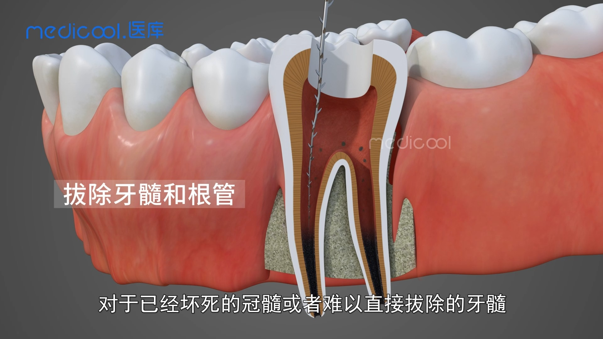 牙髓病和根尖周病的治疗,根管治疗的详细操作哔哩哔哩bilibili