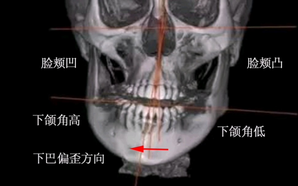 很多人不了解自己下颌骨是如何偏歪的一种形式,如图对比哔哩哔哩bilibili