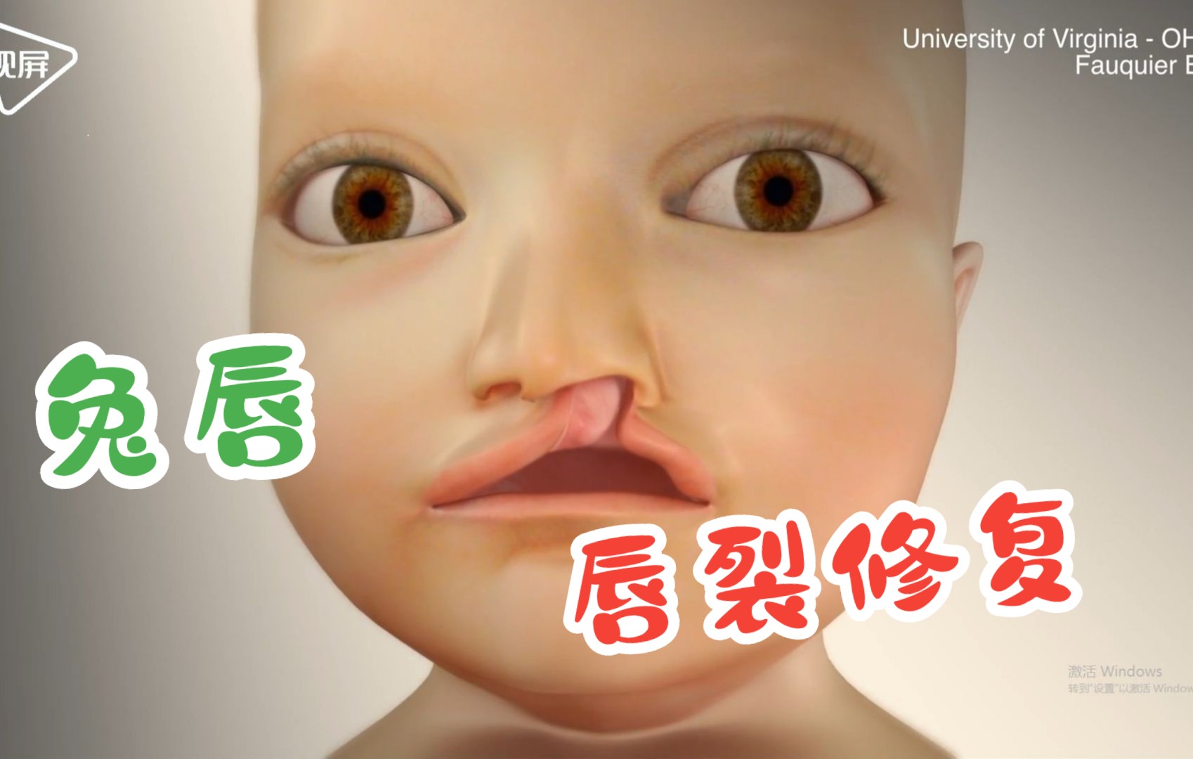 [图]【医学3D】兔唇 唇裂修复