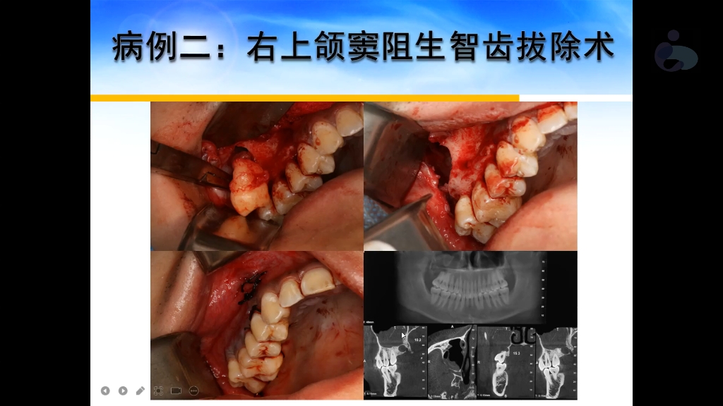 拔尽头牙过程图片