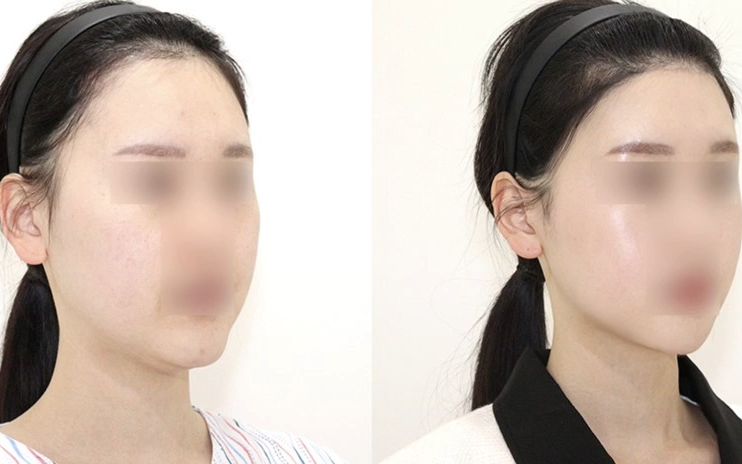 韩国1%发际线额头缩小 颧骨手术