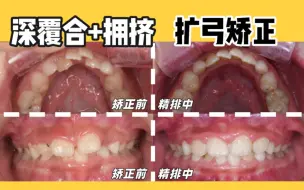 下载视频: 深覆合+拥挤，6个月扩弓矫正