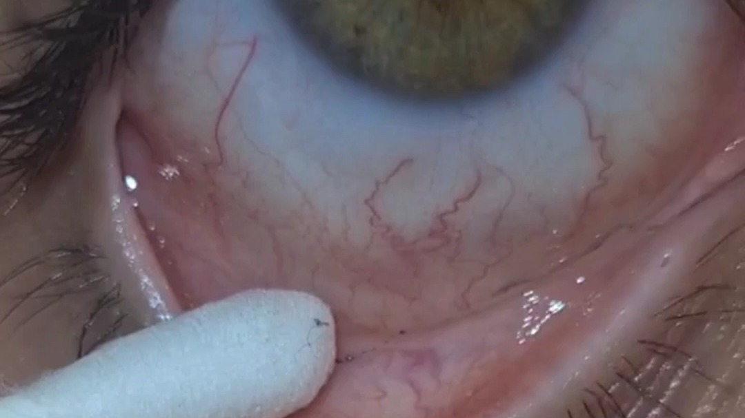 眼睛捉虫记之又一只眼睛去虫