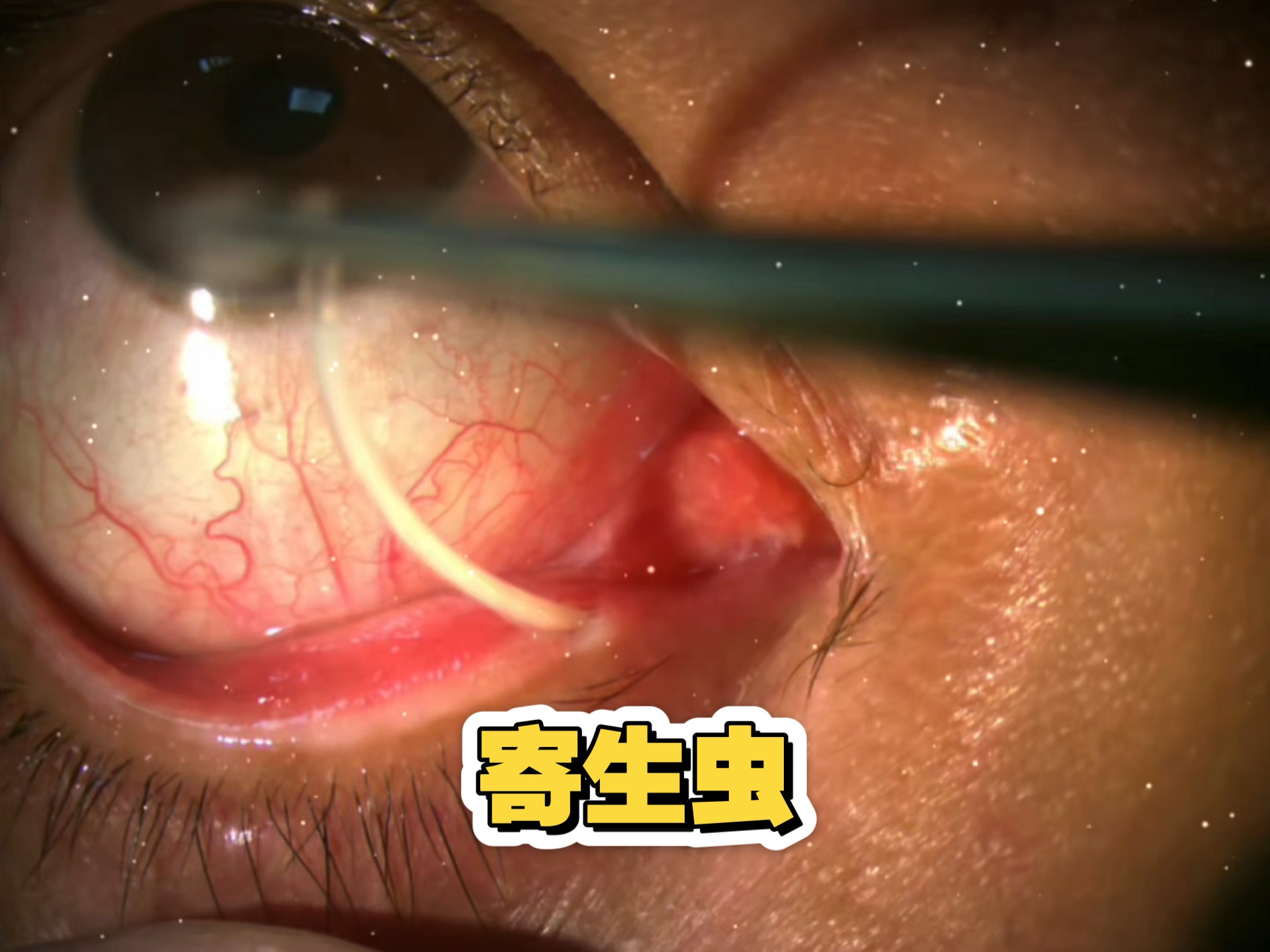 眼睛里拽出好长的寄生虫