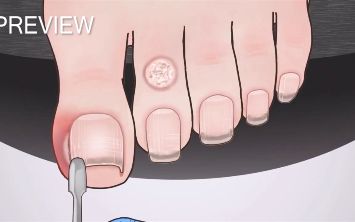 【甲沟炎】定格动画 修脚 最后太治愈了_哔哩哔哩_bilibili