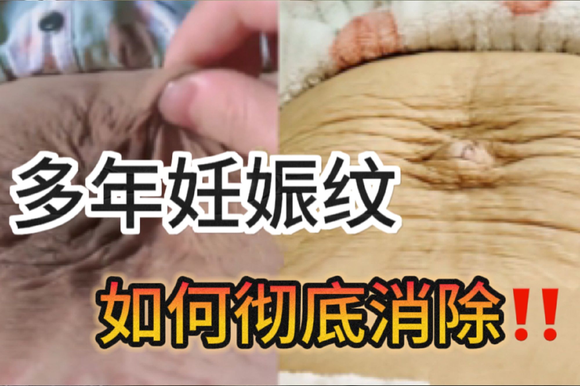 多年妊娠纹还有救吗?过来人曝光自用妙招,6年白纹说没就没!