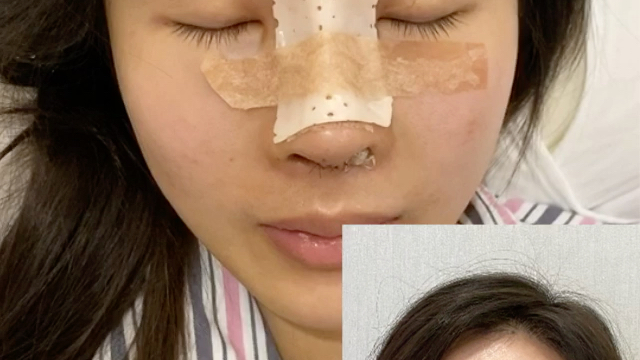 肋软骨隆鼻术后的肿胀情况_哔哩哔哩_bilibili