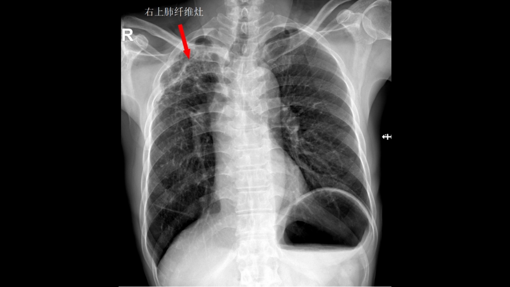 胸片正位:纤维灶和钙化灶哔哩哔哩bilibili