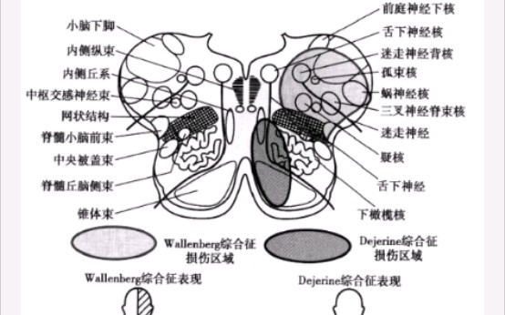 神经内科老师都喜欢提问的问题 延髓背外侧综合征哔哩哔哩bilibili