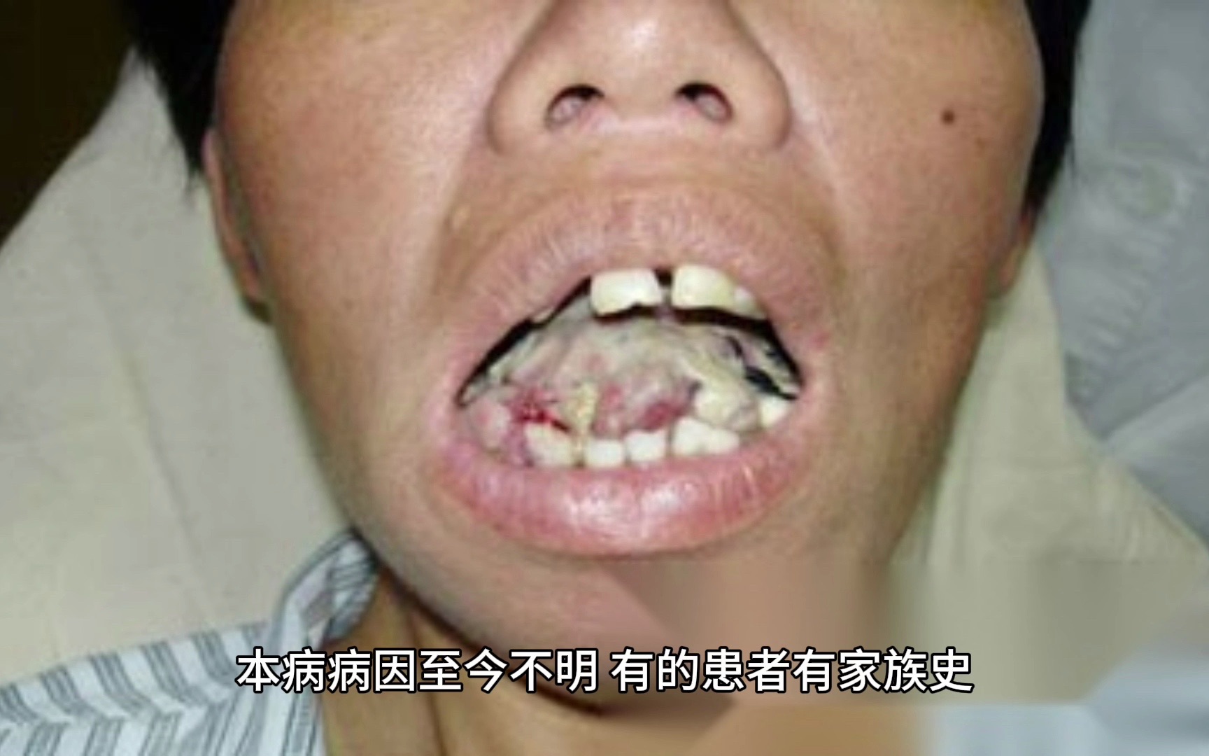 96 牙龈纤维瘤病