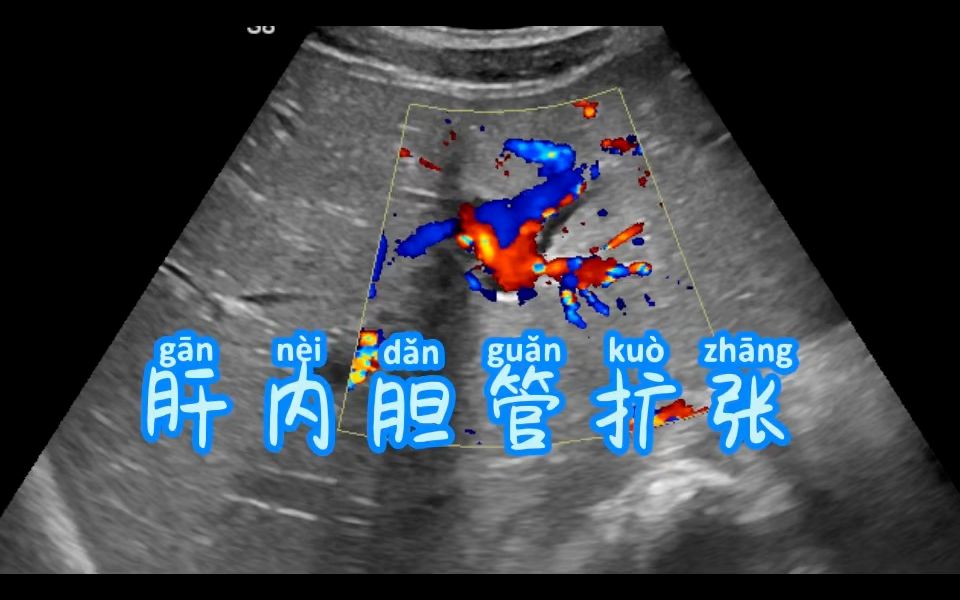 肝内胆管扩张哔哩哔哩bilibili