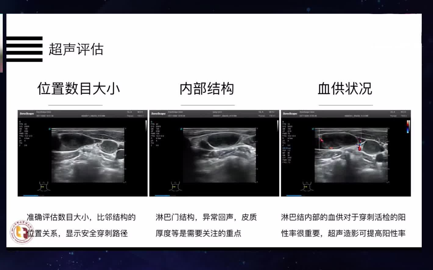 超声引导下浅表淋巴结穿刺活检 搬运自用哔哩哔哩bilibili