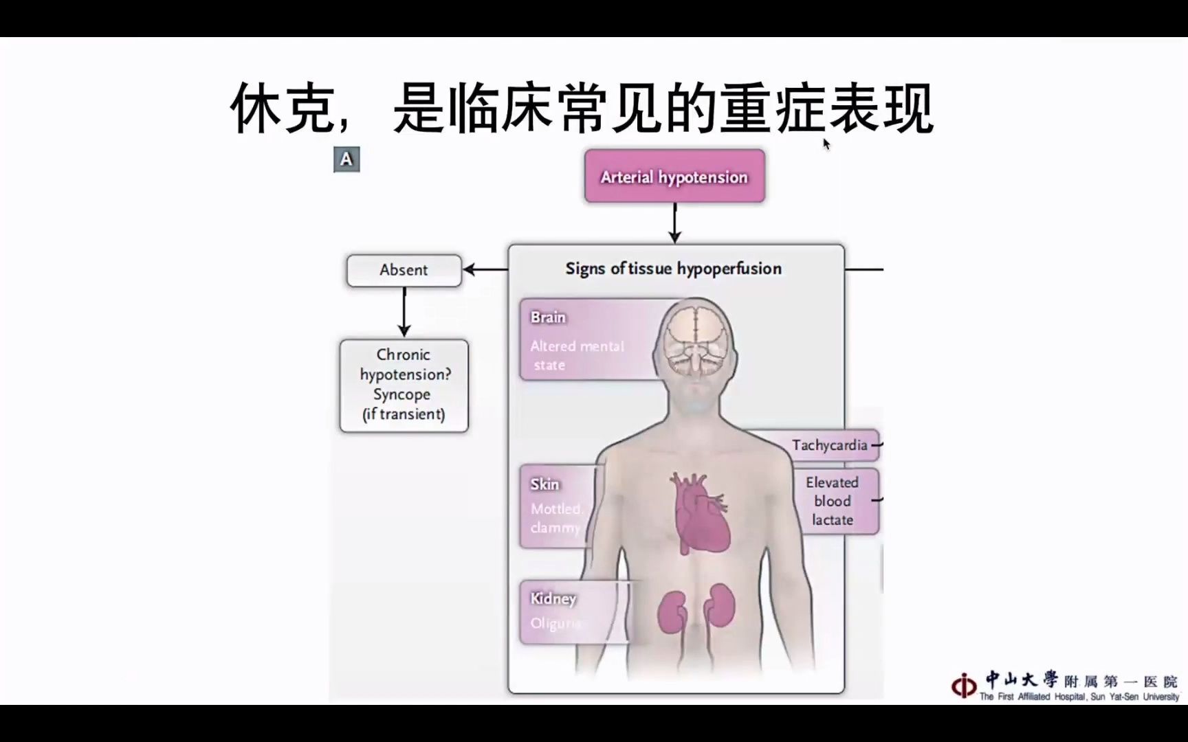 新冠肺炎救治培训(第二期):休克复苏(定点医院国家级巡回专家—管向东教授).mp4哔哩哔哩bilibili