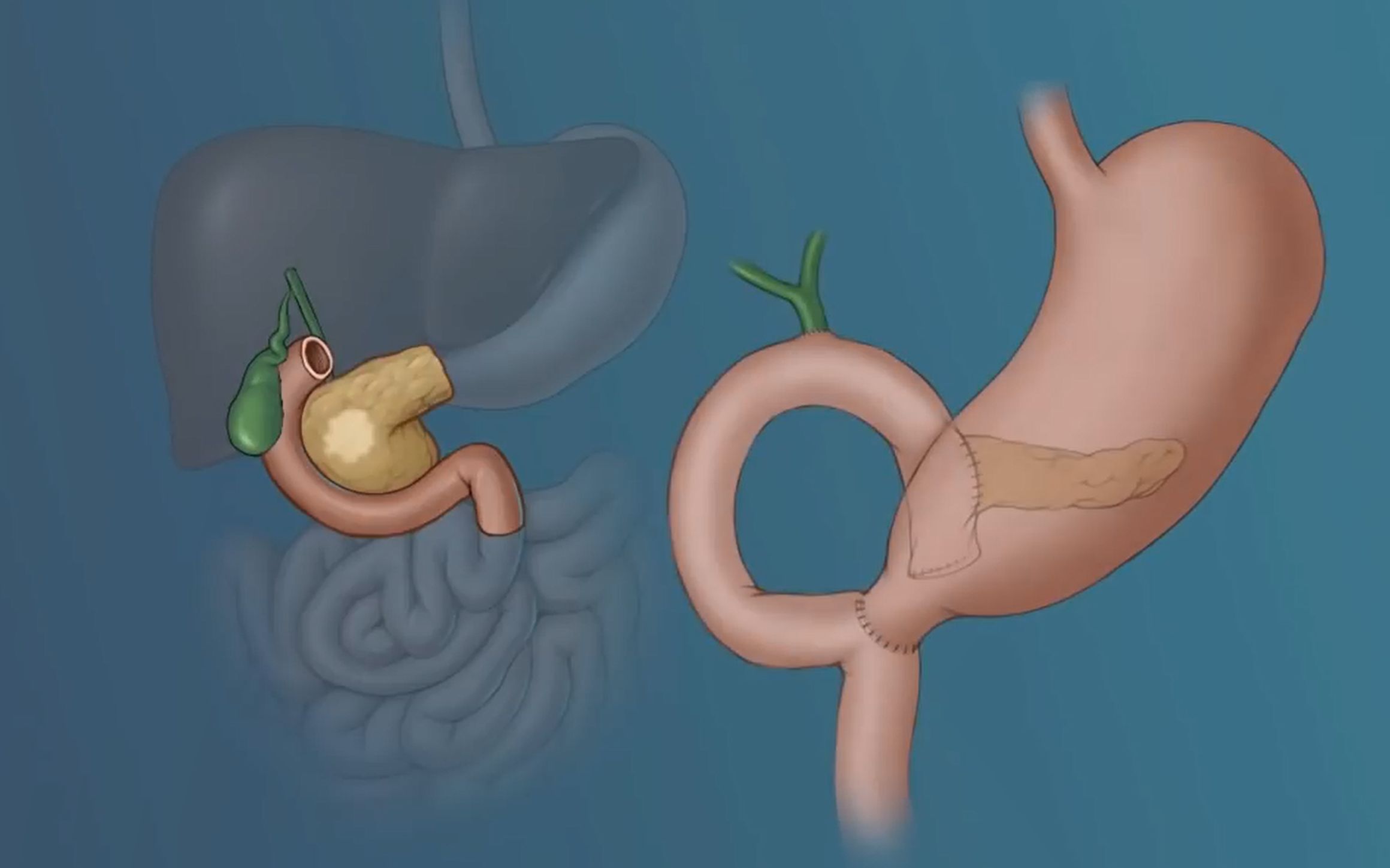 【搬运工】the whipple procedure 胰十二指肠切除术(johns hopkins