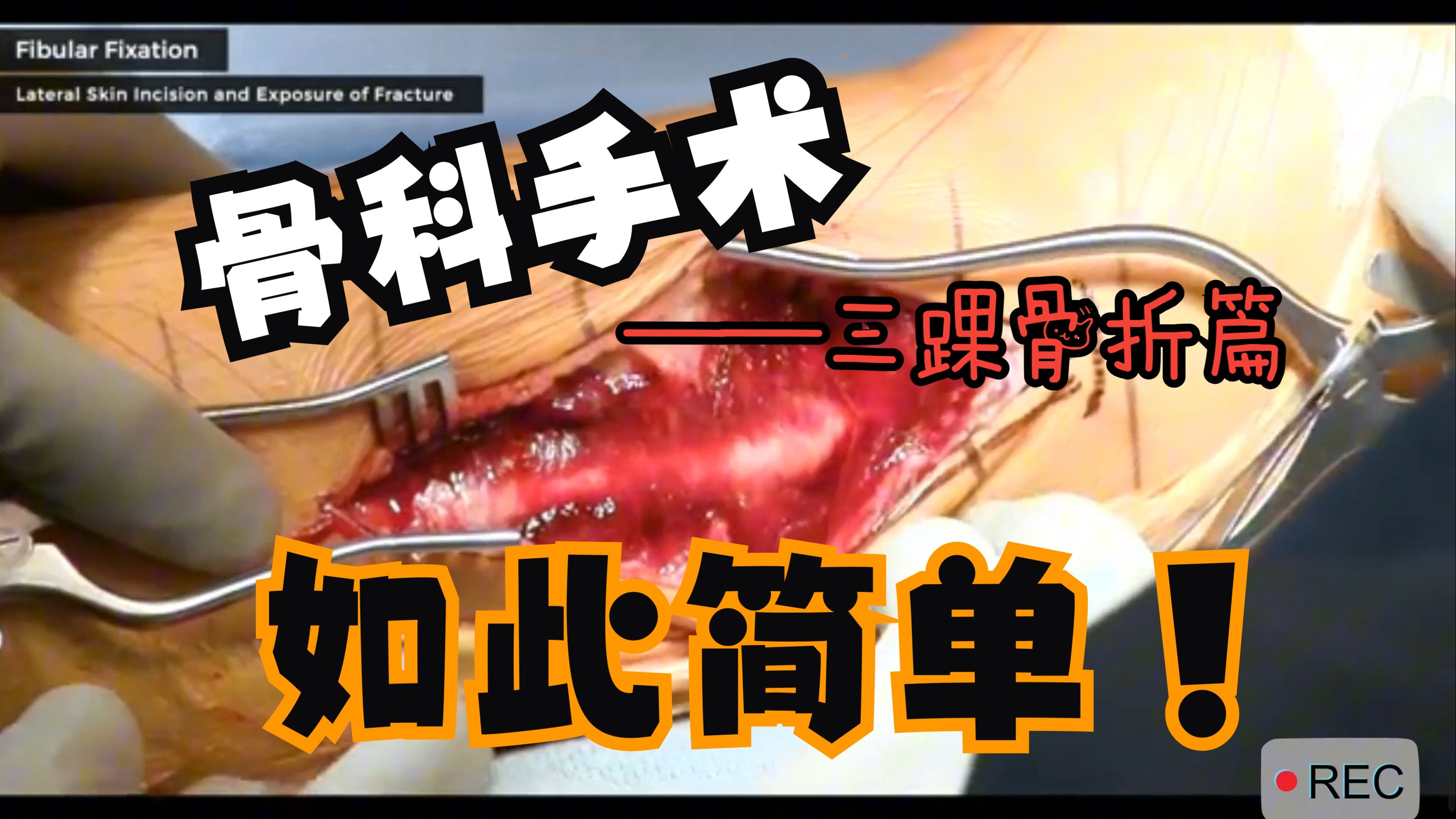 【4K骨科手术视频教学】三踝骨折+下胫腓联合损伤全流程 | 真实病例高清还原，踝关节重建的每一步都不能错！