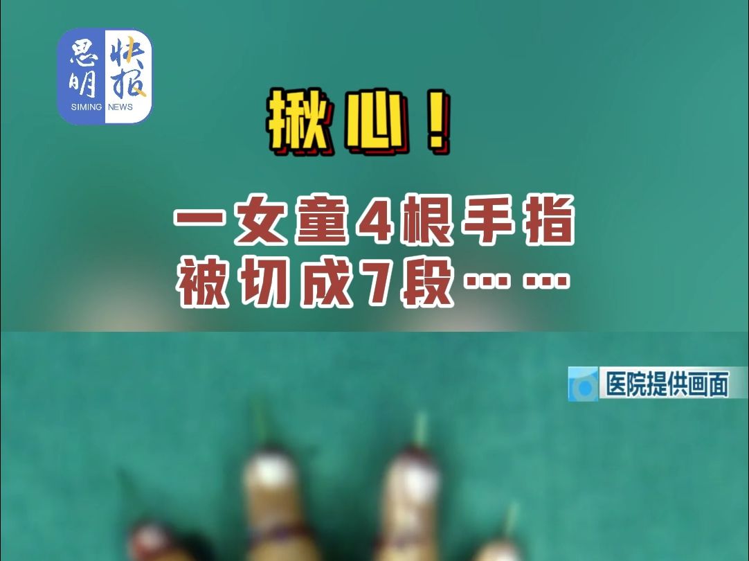 揪心!一女童4根手指被切成7段…… #意外 #手指 #切片刀 (资料来源:昆明广播电视台、浙大儿院、新闻坊、厦门日报)哔哩哔哩bilibili