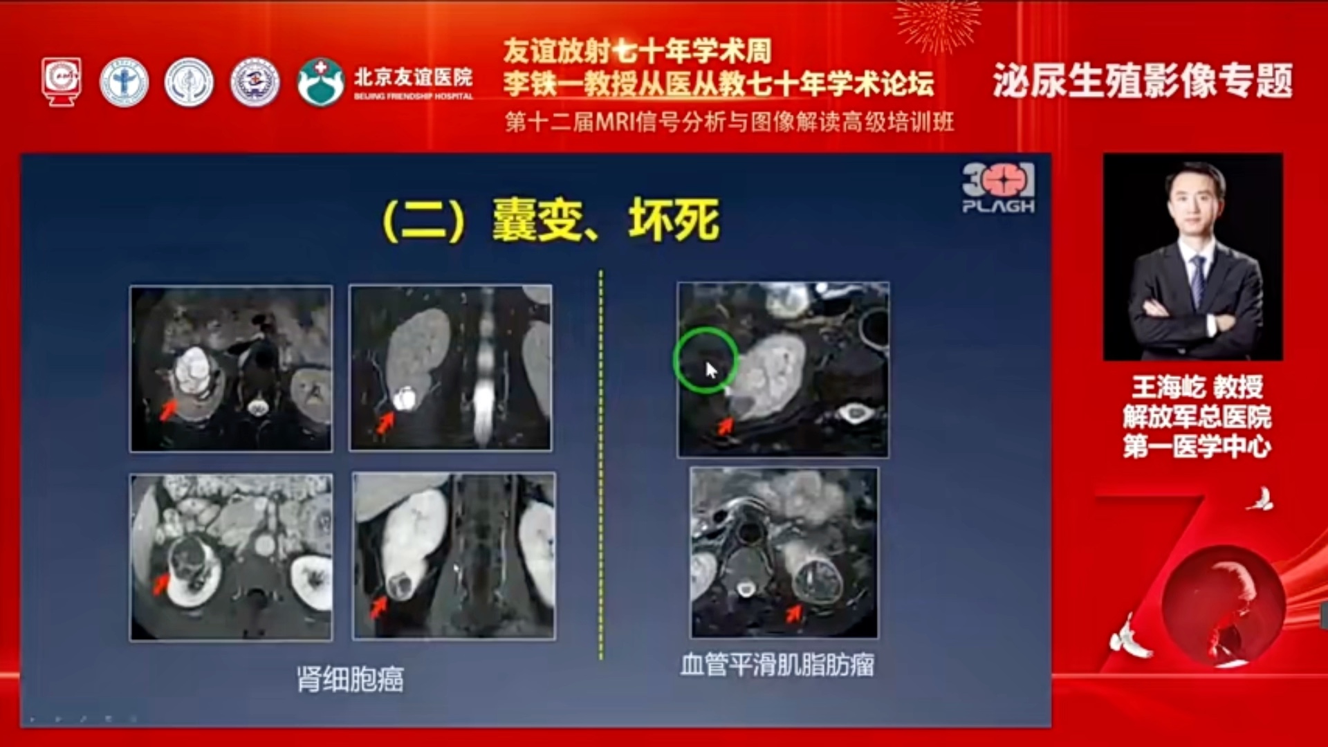 肾脏实性肿瘤MRI诊断思路 解放军总医院放射科(3)哔哩哔哩bilibili