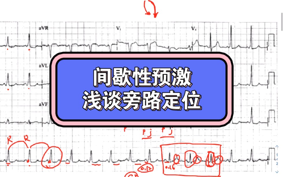 略不典型的间歇性预激 浅谈预激旁路哔哩哔哩bilibili