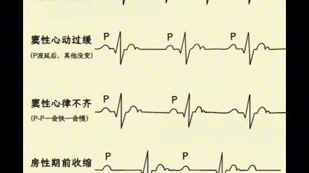 你敢学吗?正常心电图表现,这还记不下来?哔哩哔哩bilibili