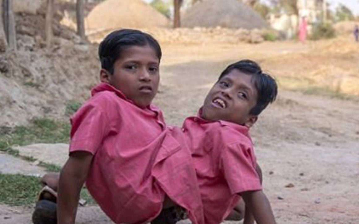 印度连体双胞胎6只手足犹如蜘蛛被人当做神灵