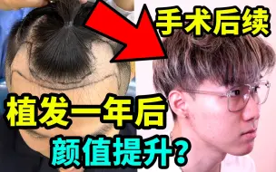 Download Video: 植发一年最终效果！！堪比整容？走心大分享