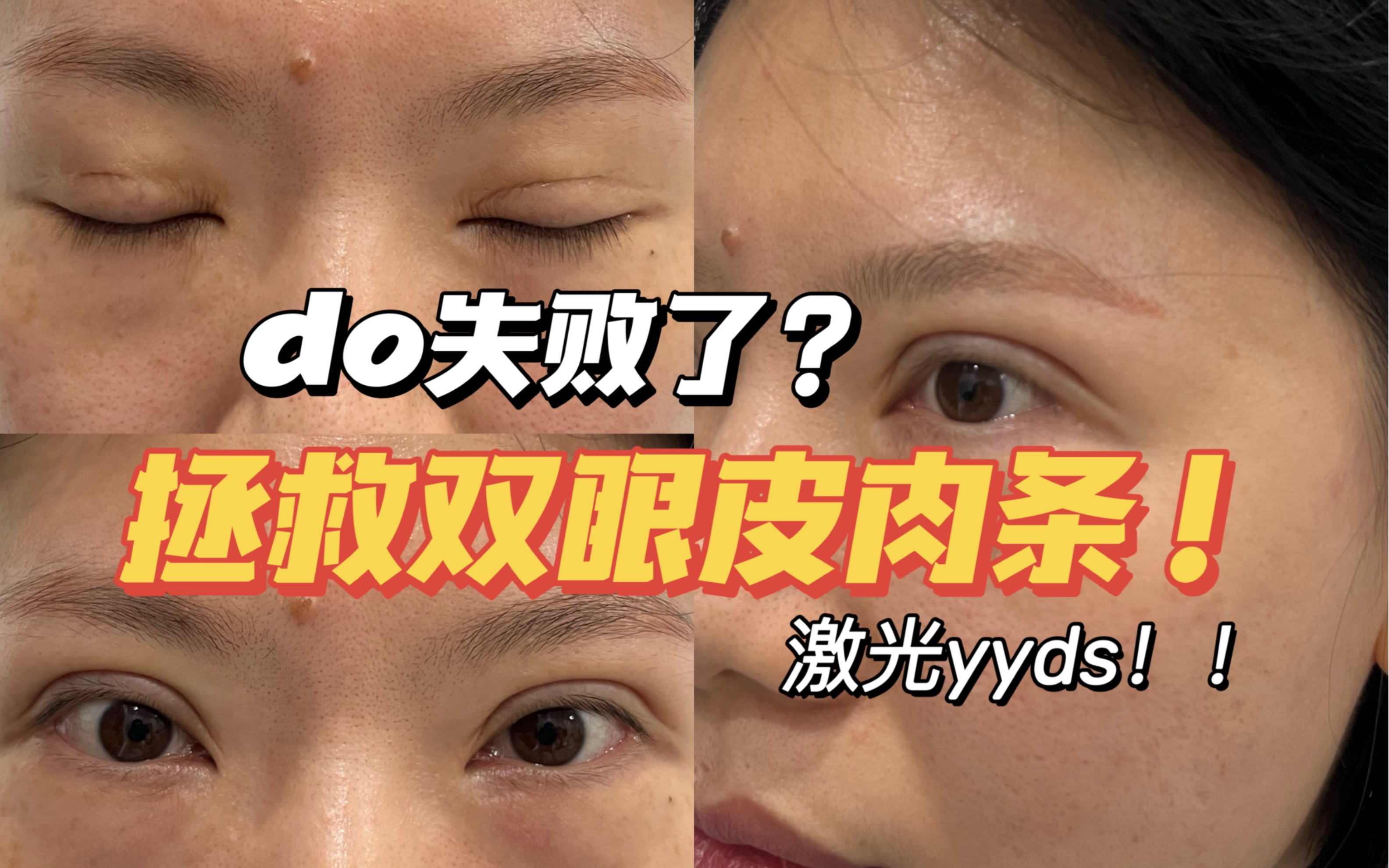 激光修复双眼皮肉条,ko肿胀感!